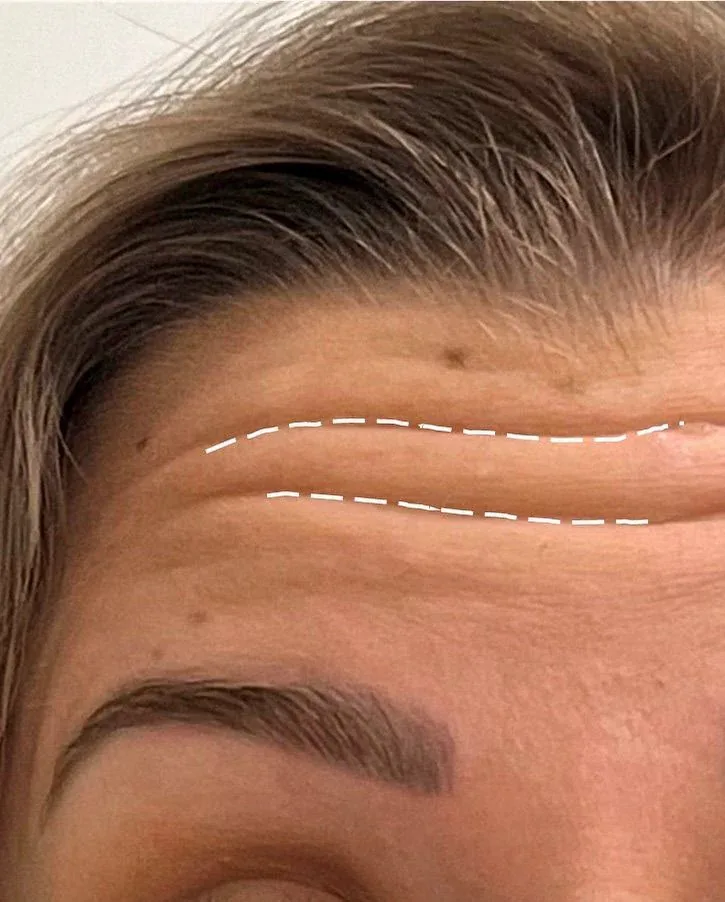 Botox